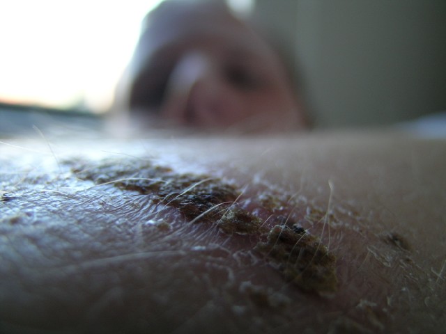 scab